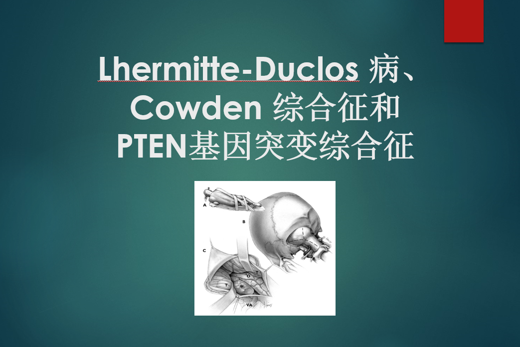 ldd,cowden 综合征和pten基因突变综合征